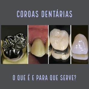 Coroa dentária: quais os tipos e suas características